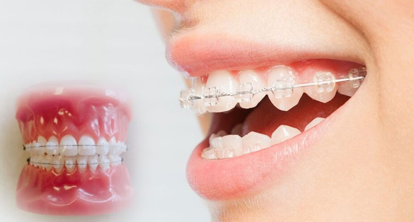 best clear braces