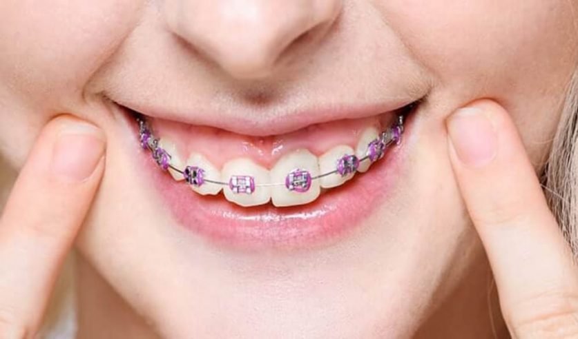 braces colors