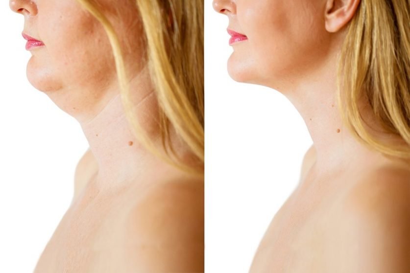 Neck Liposuction