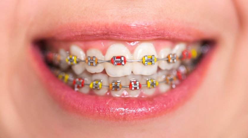 Braces Colors