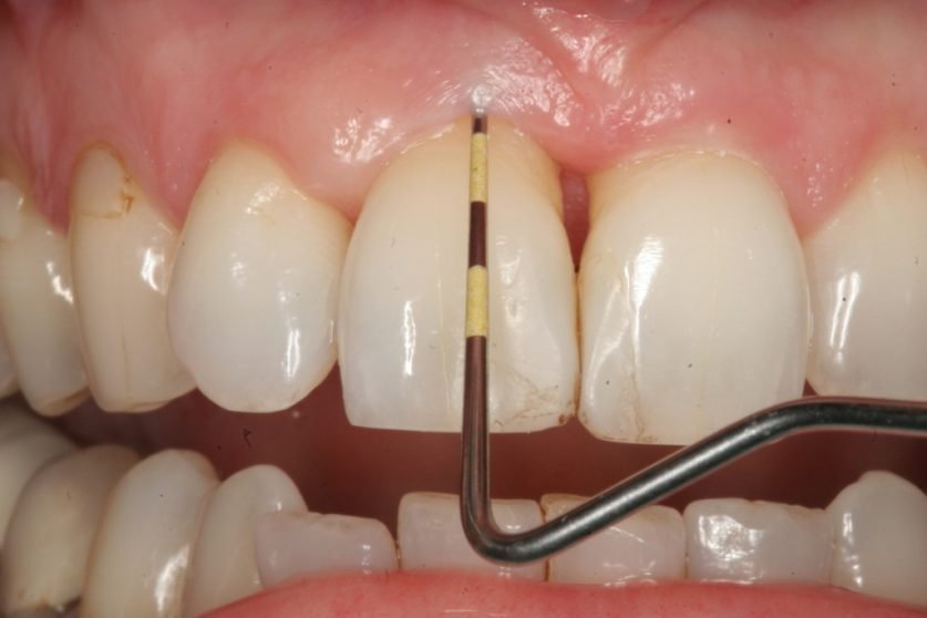 Periodontitis Treatment