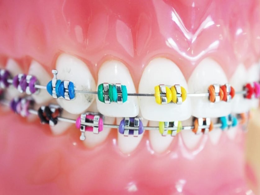 braces colors