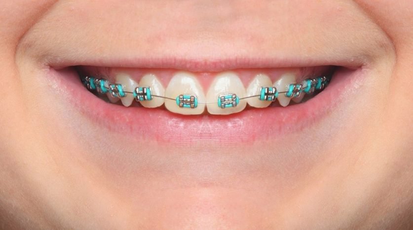 Light Blue Braces