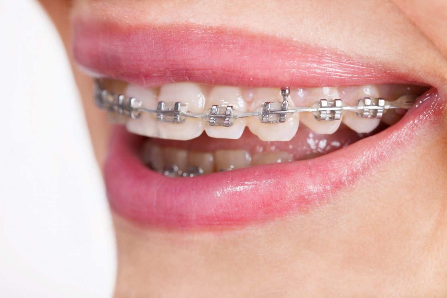 overbite braces