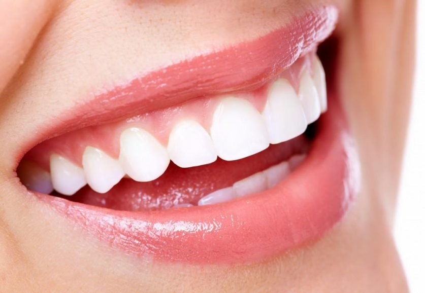 dental veneers