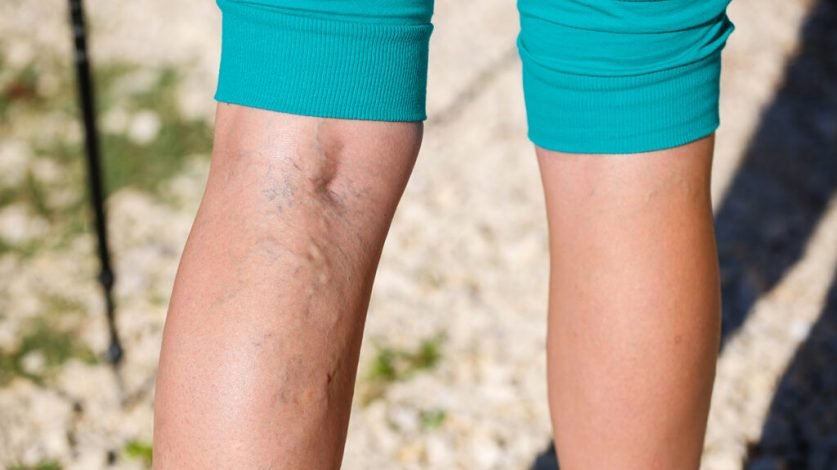 Varicose Veins