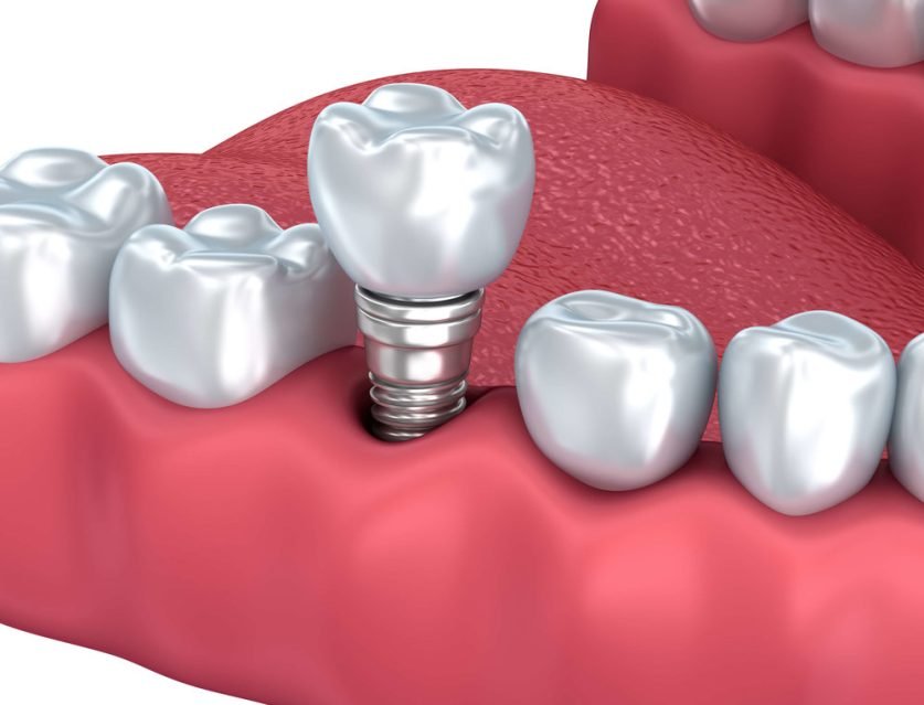 Dental Implant