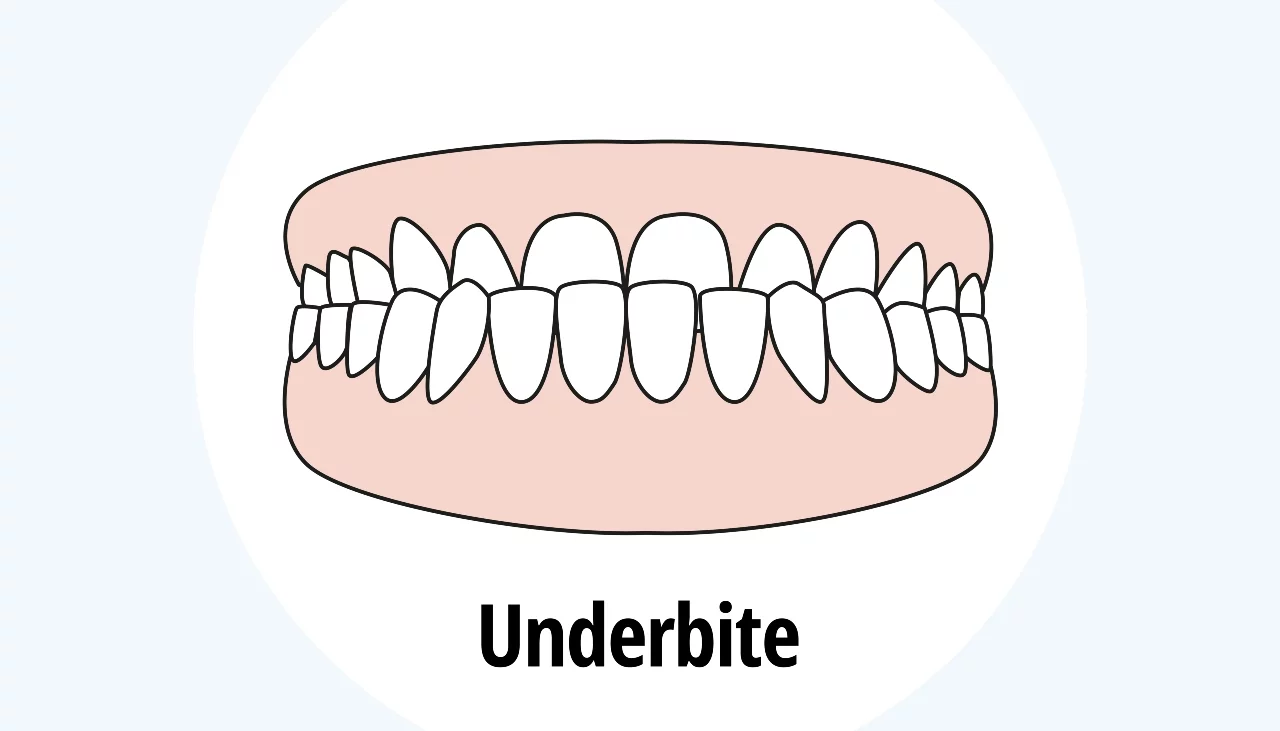 Underbite