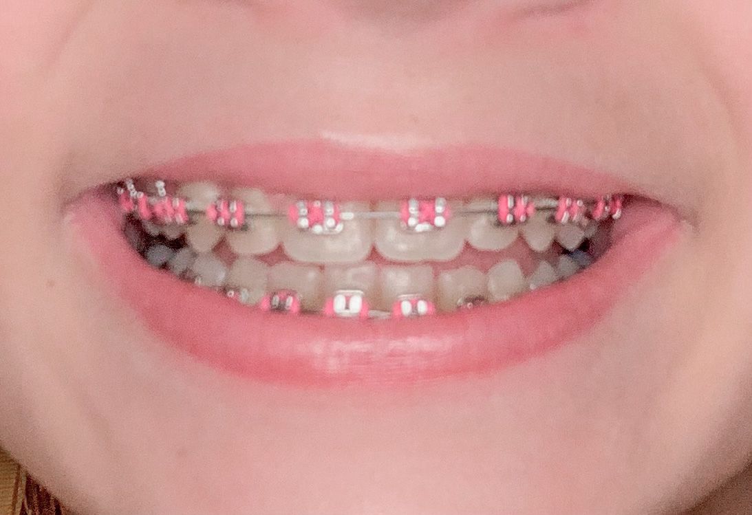 light pink braces