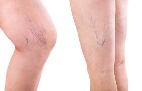 Does spider vein removal really work