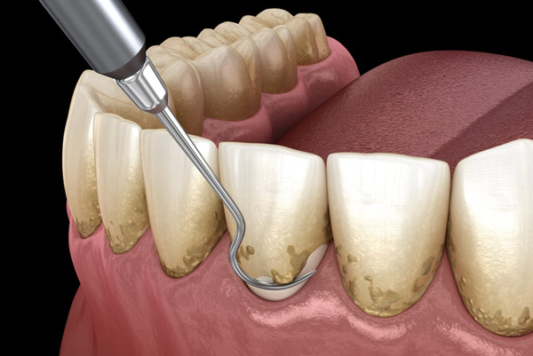 periodontal maintenance in Houston Heights