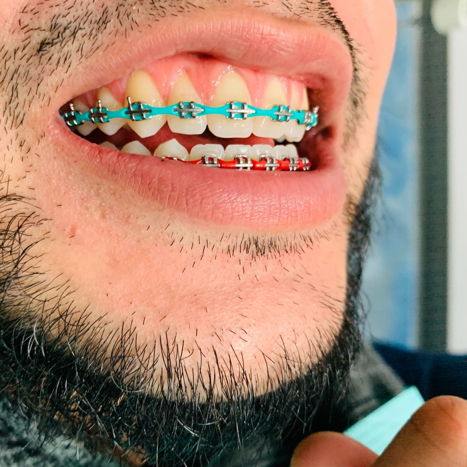 braces colors that make your teeth look whiter