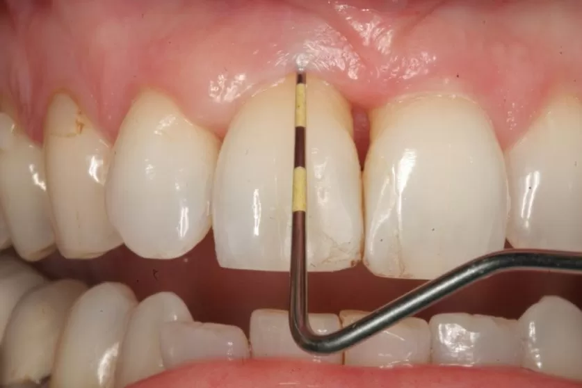 Periodontitis Treatment