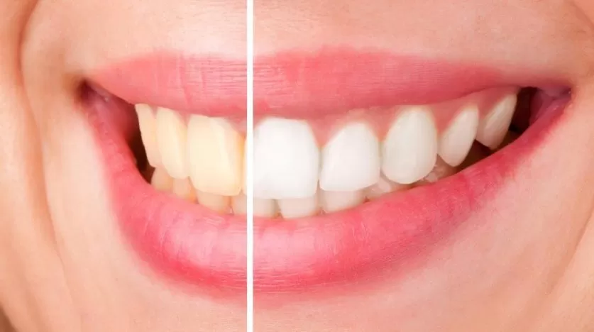 Teeth Bleaching