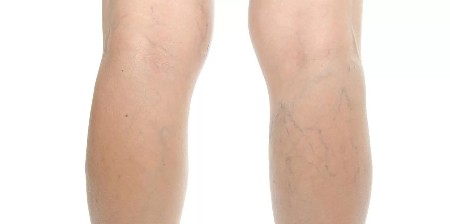 Varicose Veins