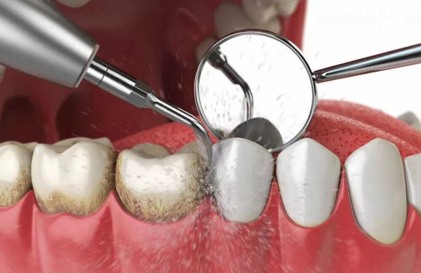 Periodontal Therapy