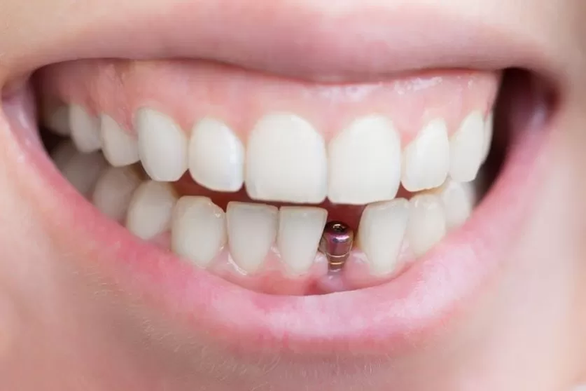 Tooth Implant