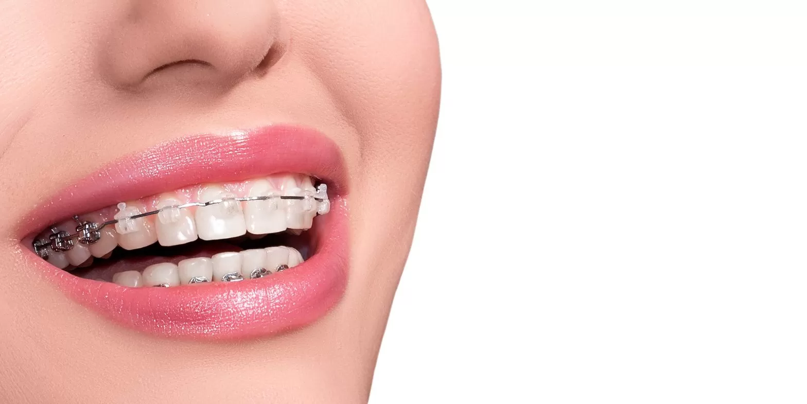 Braces