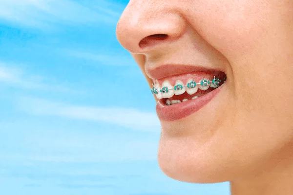Best Age To Get Braces