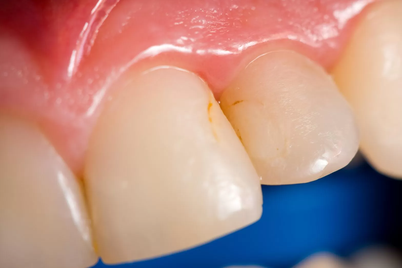 Brown Spots on Teeth