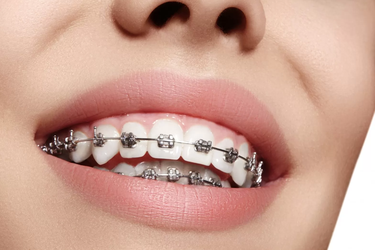 Braces Procedure