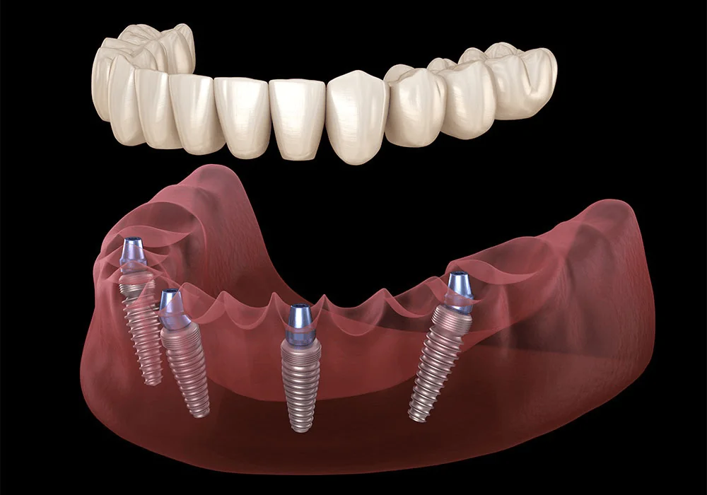 All on 4 Dental Implant Houston