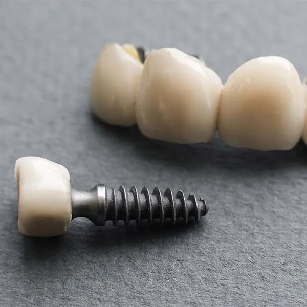 Teeth Implants Cost Near Me